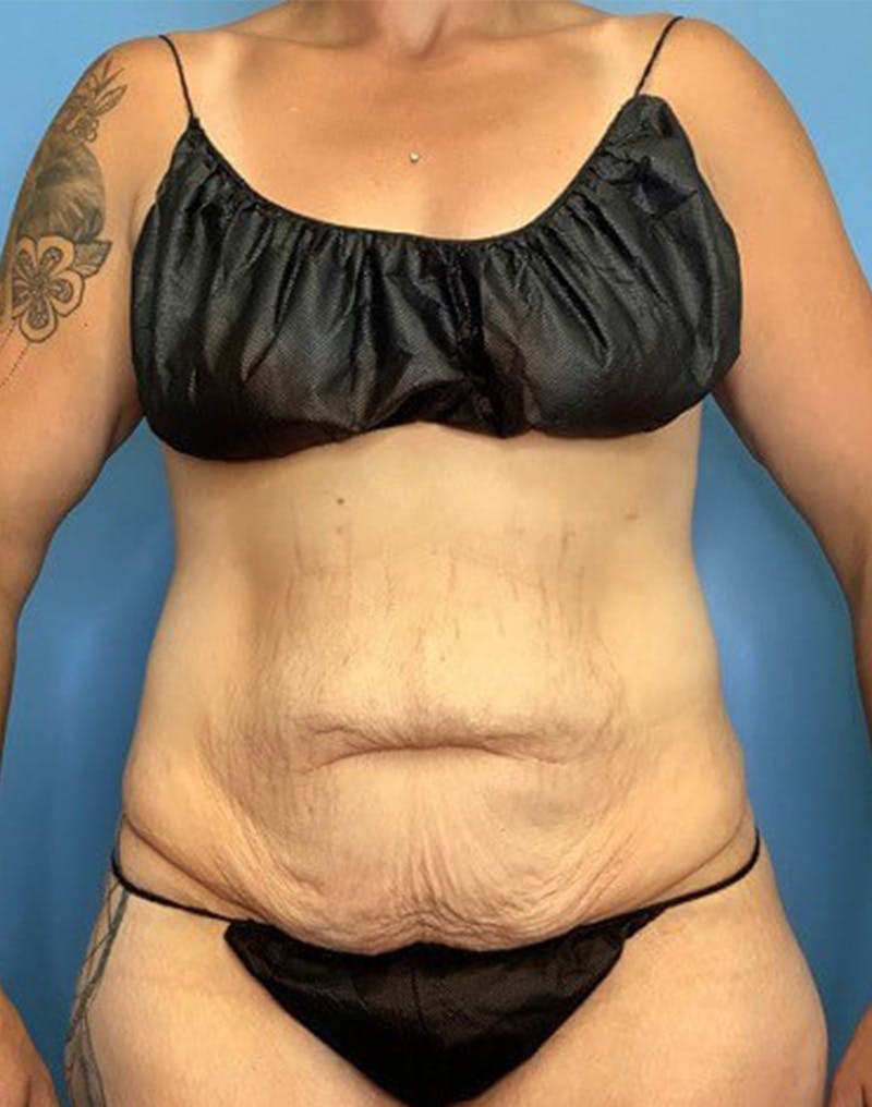 Tummy Tuck (Abdominoplasty)  Before & After Gallery - Patient 55612924 - Image 1