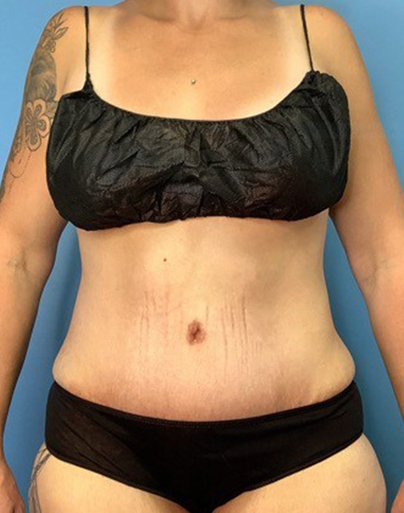 Tummy Tuck (Abdominoplasty)  Before & After Gallery - Patient 55612924 - Image 2