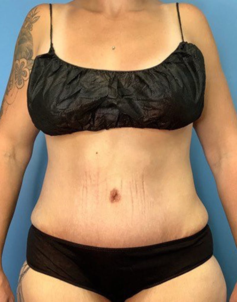 Tummy Tuck (Abdominoplasty)  Before & After Gallery - Patient 55612924 - Image 2
