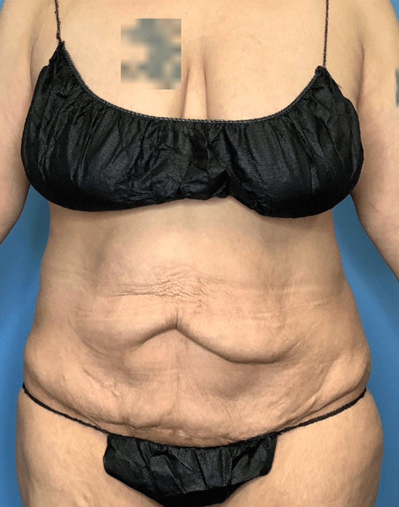 Tummy Tuck (Abdominoplasty)  Before & After Gallery - Patient 55612932 - Image 1