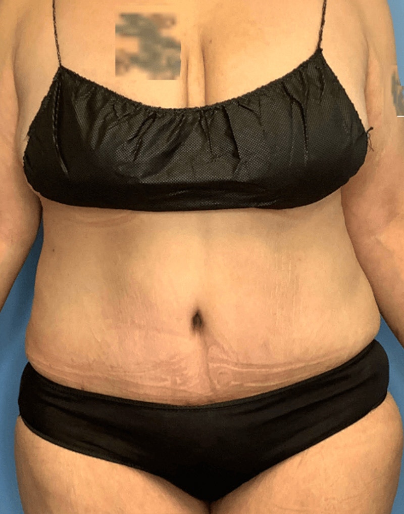 Tummy Tuck (Abdominoplasty)  Before & After Gallery - Patient 55612932 - Image 2