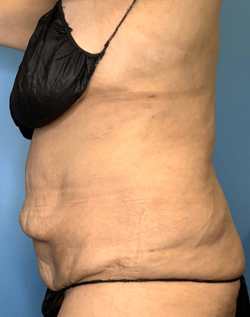 Tummy Tuck (Abdominoplasty)  Before & After Gallery - Patient 55612932 - Image 3