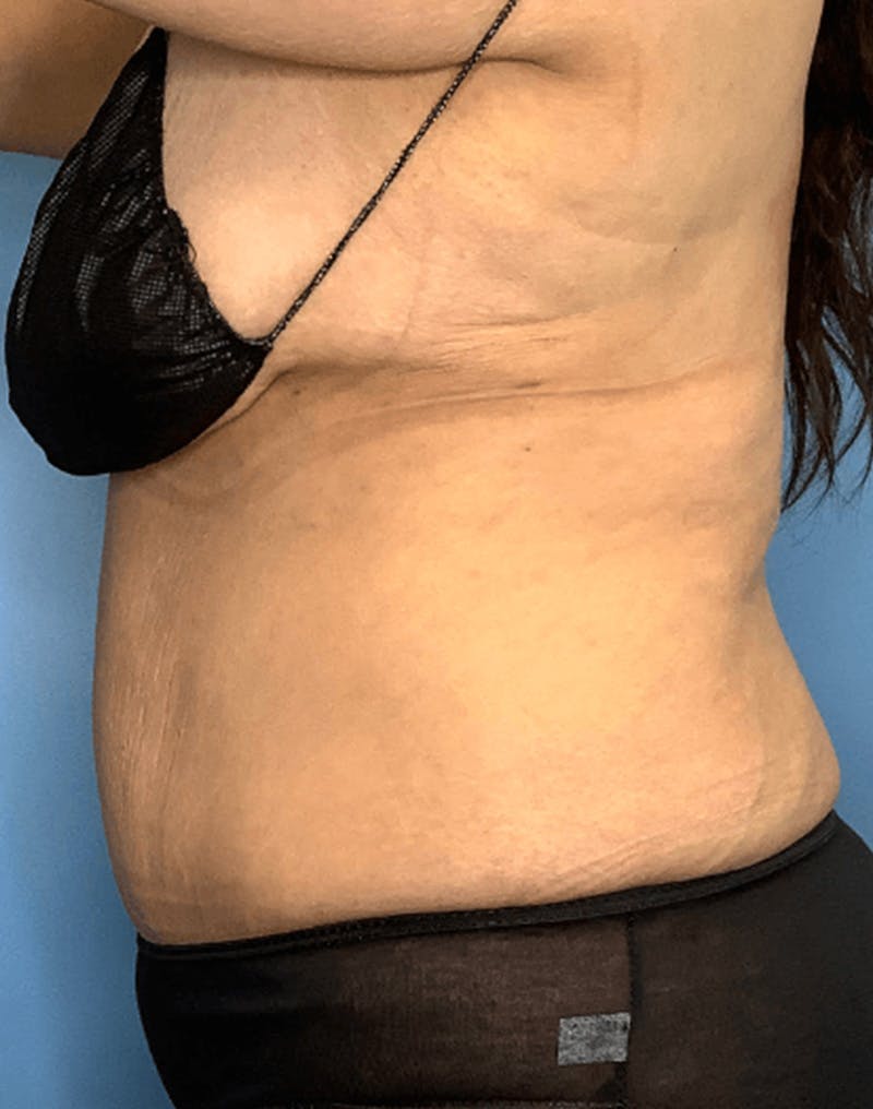 Tummy Tuck (Abdominoplasty)  Before & After Gallery - Patient 55612932 - Image 4