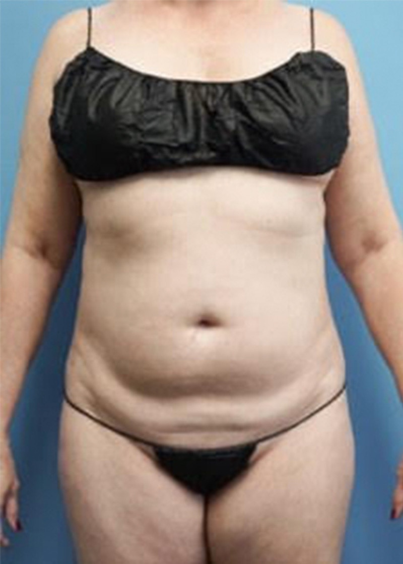 Vaser Liposuction Before & After Gallery - Patient 133182815 - Image 1
