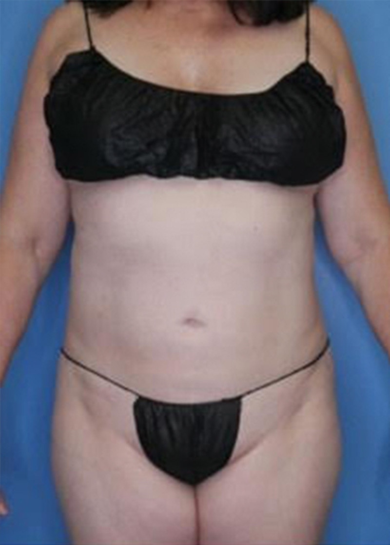 Vaser Liposuction Before & After Gallery - Patient 133182815 - Image 2