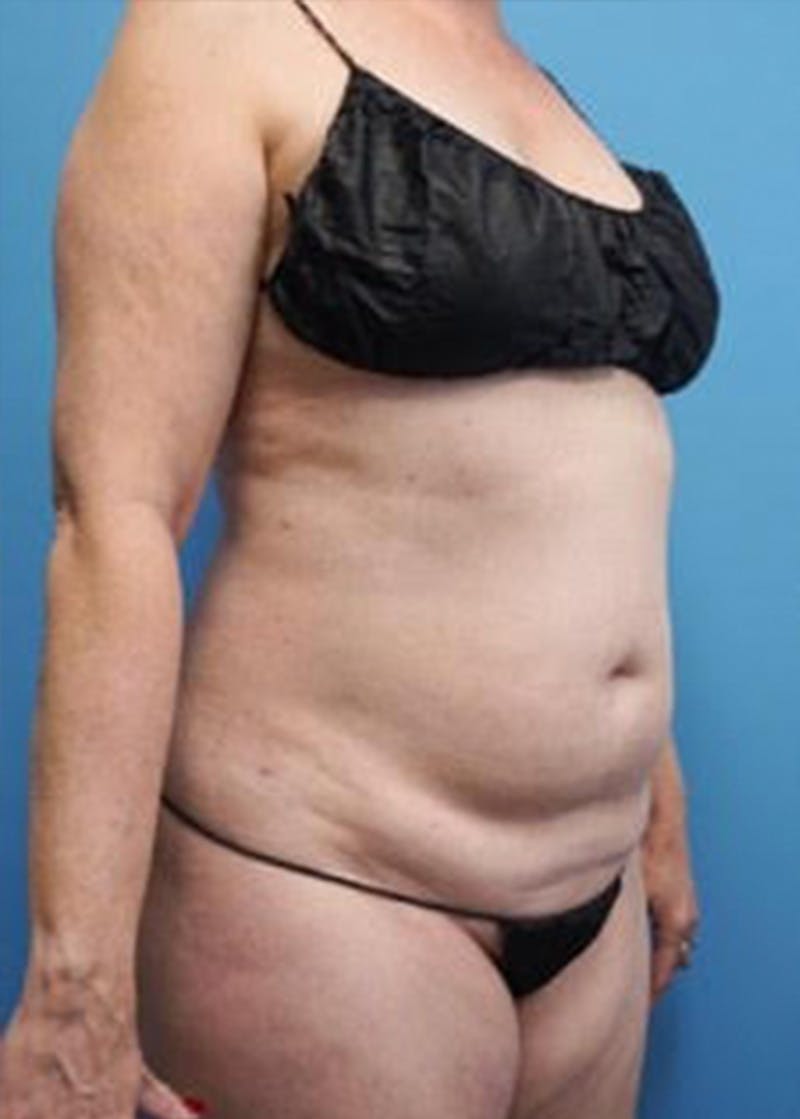 Vaser Liposuction Before & After Gallery - Patient 133182815 - Image 3