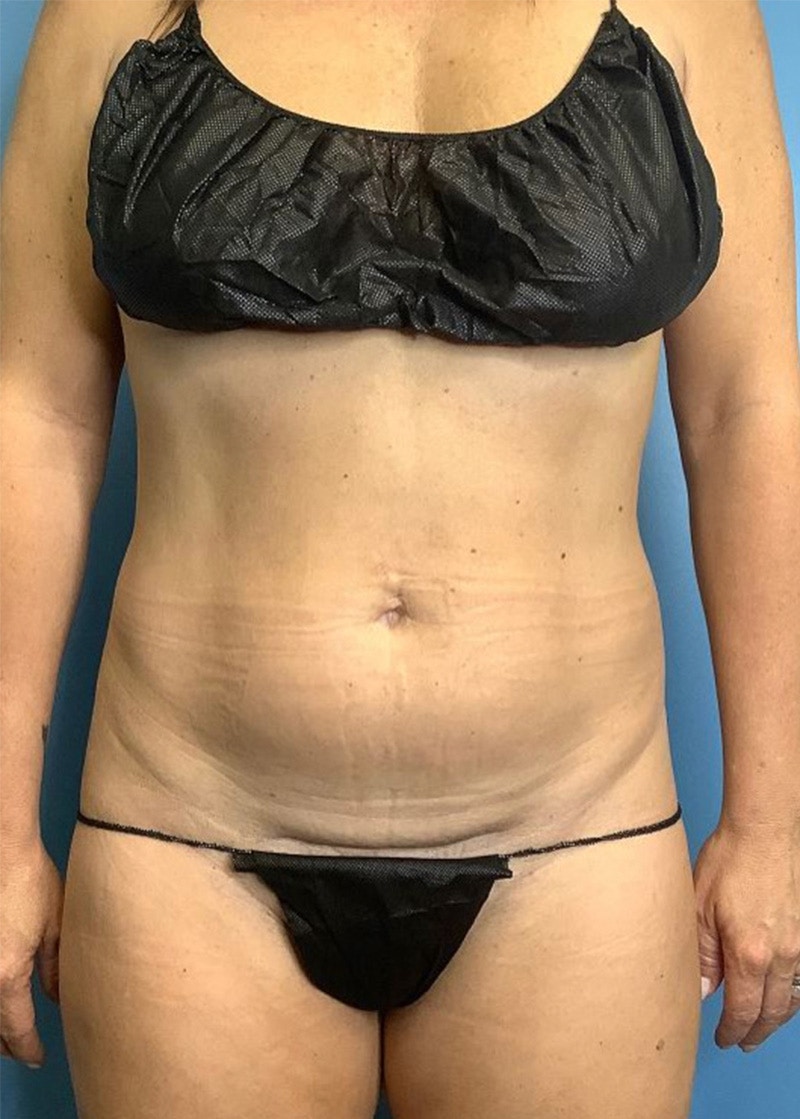 Vaser Liposuction Before & After Gallery - Patient 86645062 - Image 1
