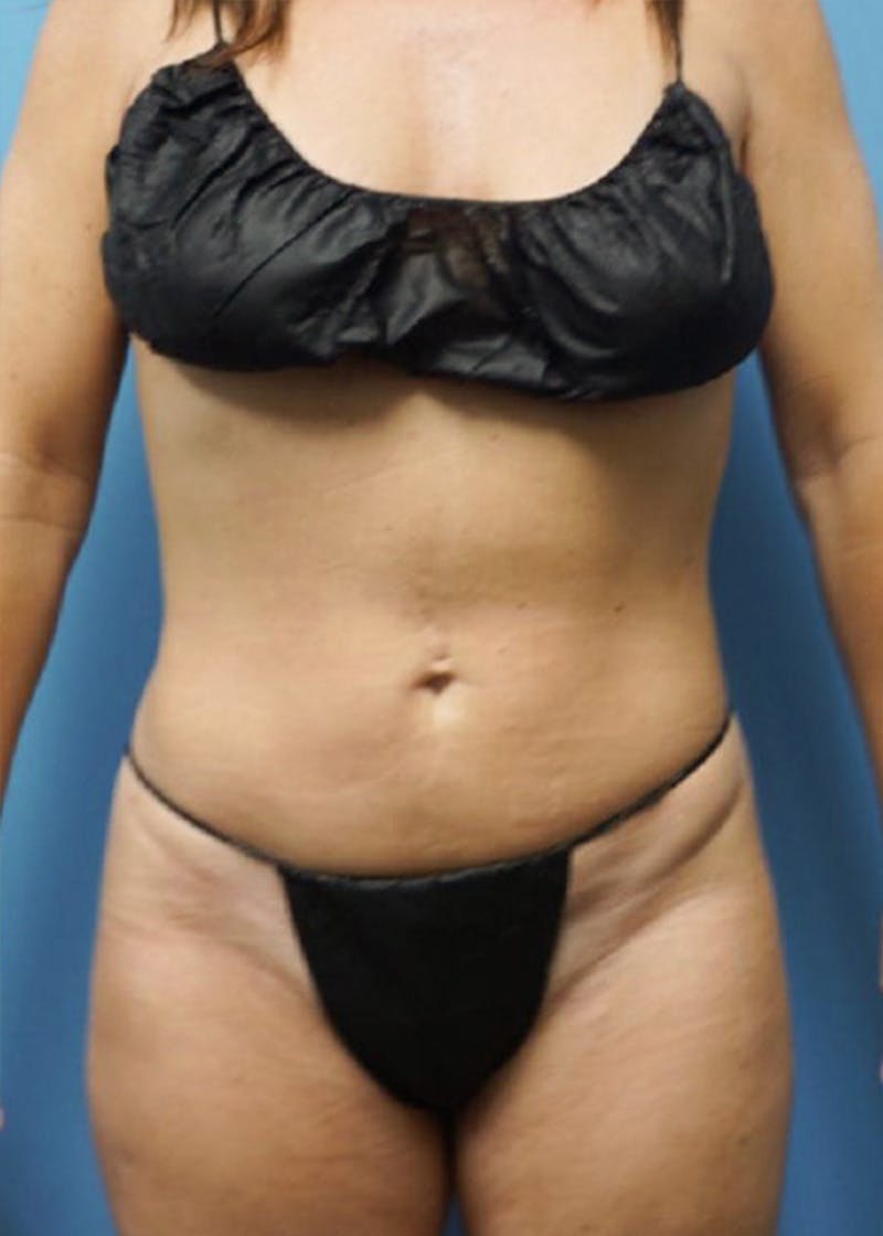 Vaser Liposuction Before & After Gallery - Patient 86645062 - Image 2