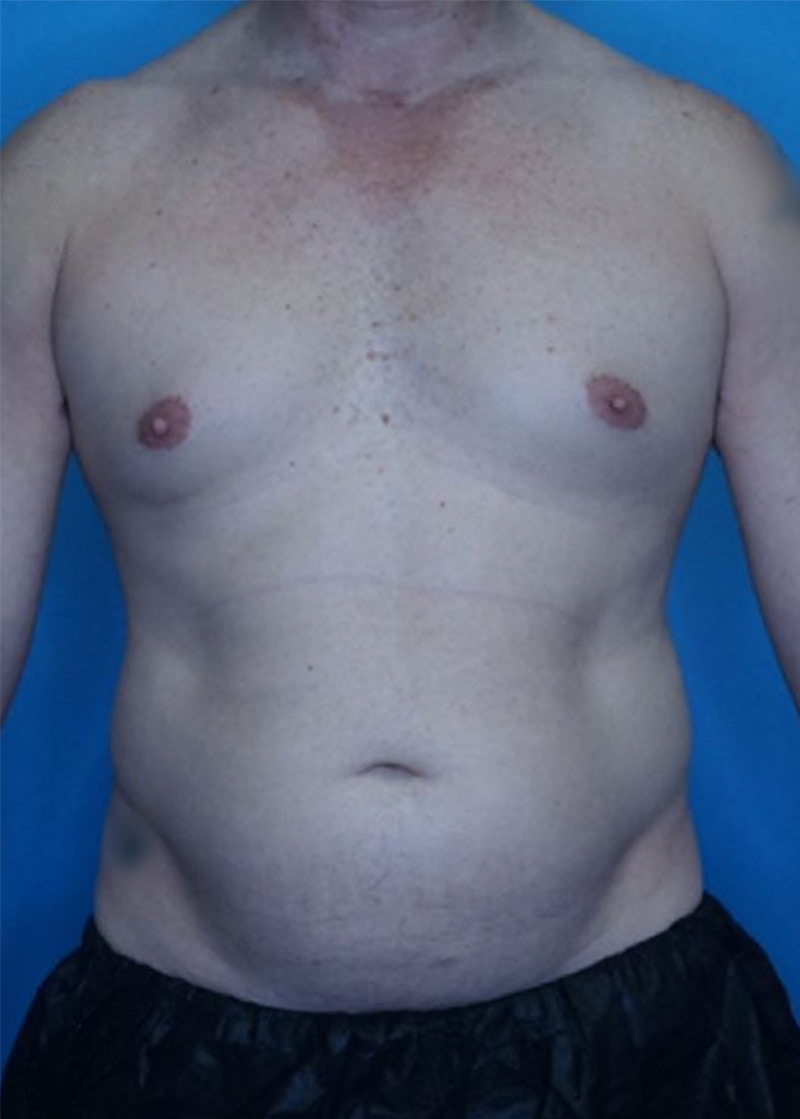 Vaser Liposuction Before & After Gallery - Patient 86837227 - Image 1