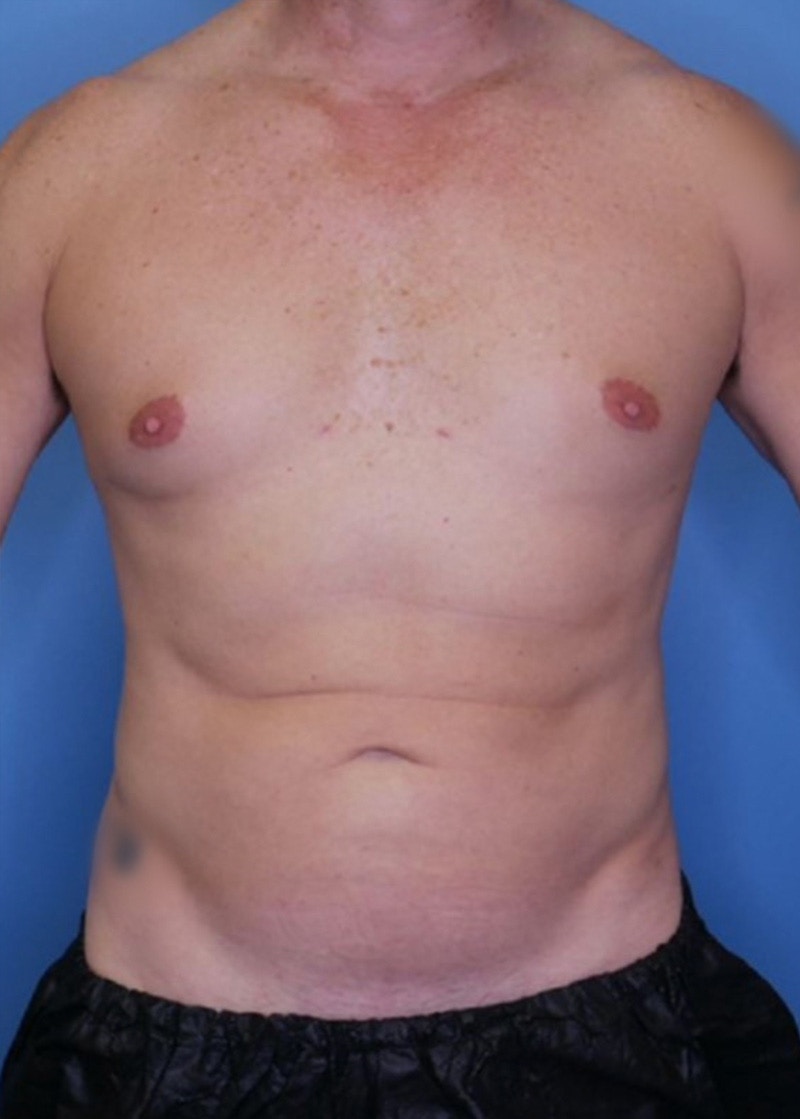 Vaser Liposuction Before & After Gallery - Patient 86837227 - Image 2