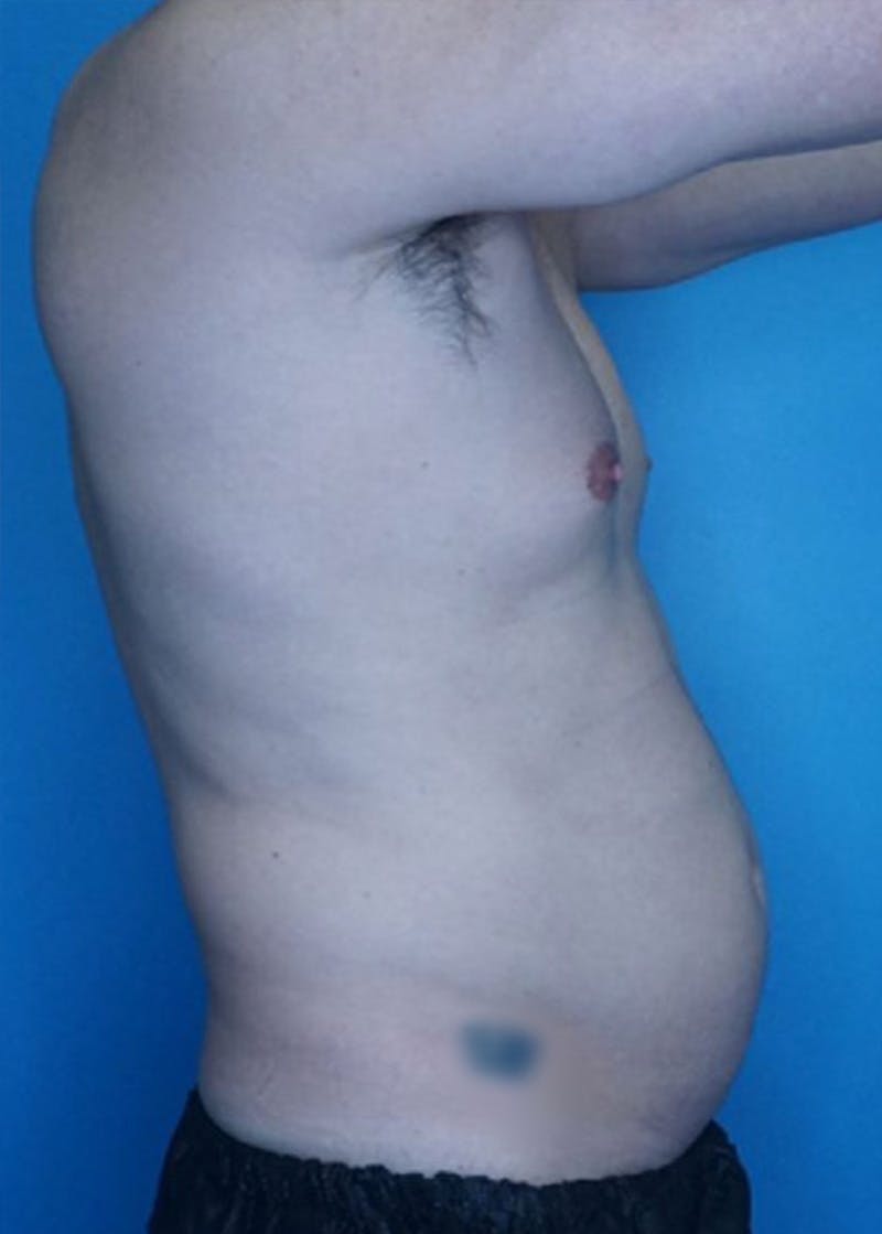 Vaser Liposuction Before & After Gallery - Patient 86837227 - Image 3