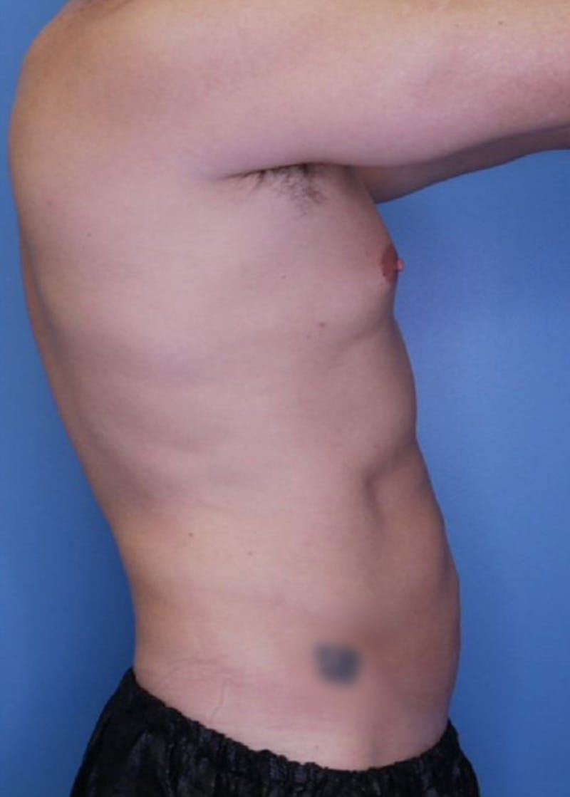 Vaser Liposuction Before & After Gallery - Patient 86837227 - Image 4