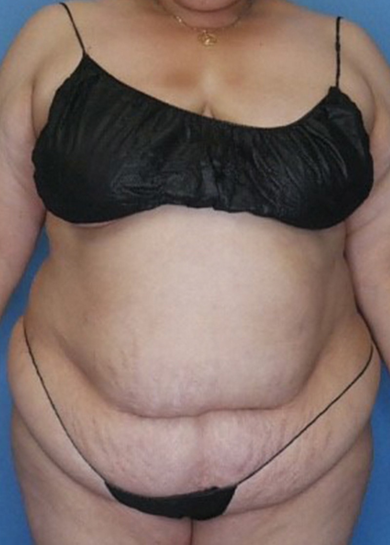 Vaser Liposuction Before & After Gallery - Patient 133182754 - Image 1