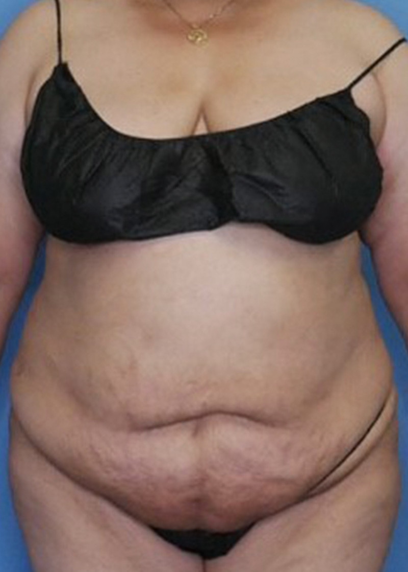 Vaser Liposuction Before & After Gallery - Patient 133182754 - Image 2