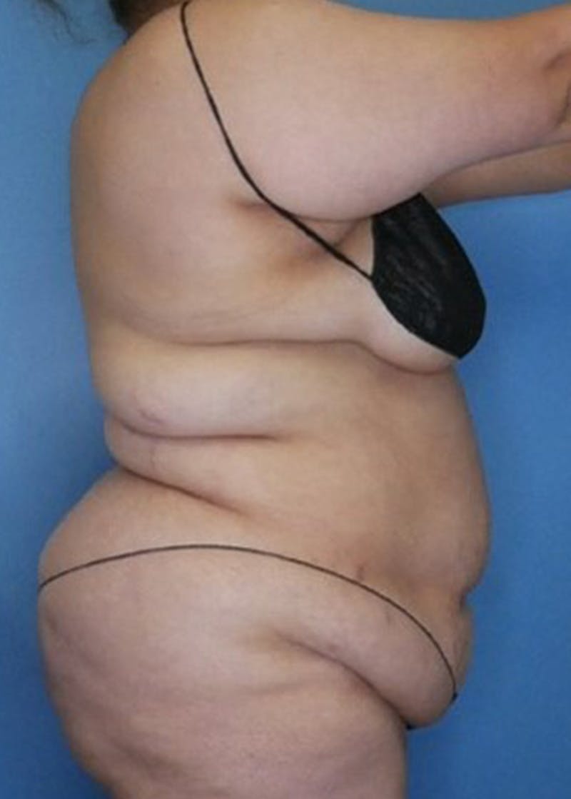 Vaser Liposuction Before & After Gallery - Patient 133182754 - Image 3