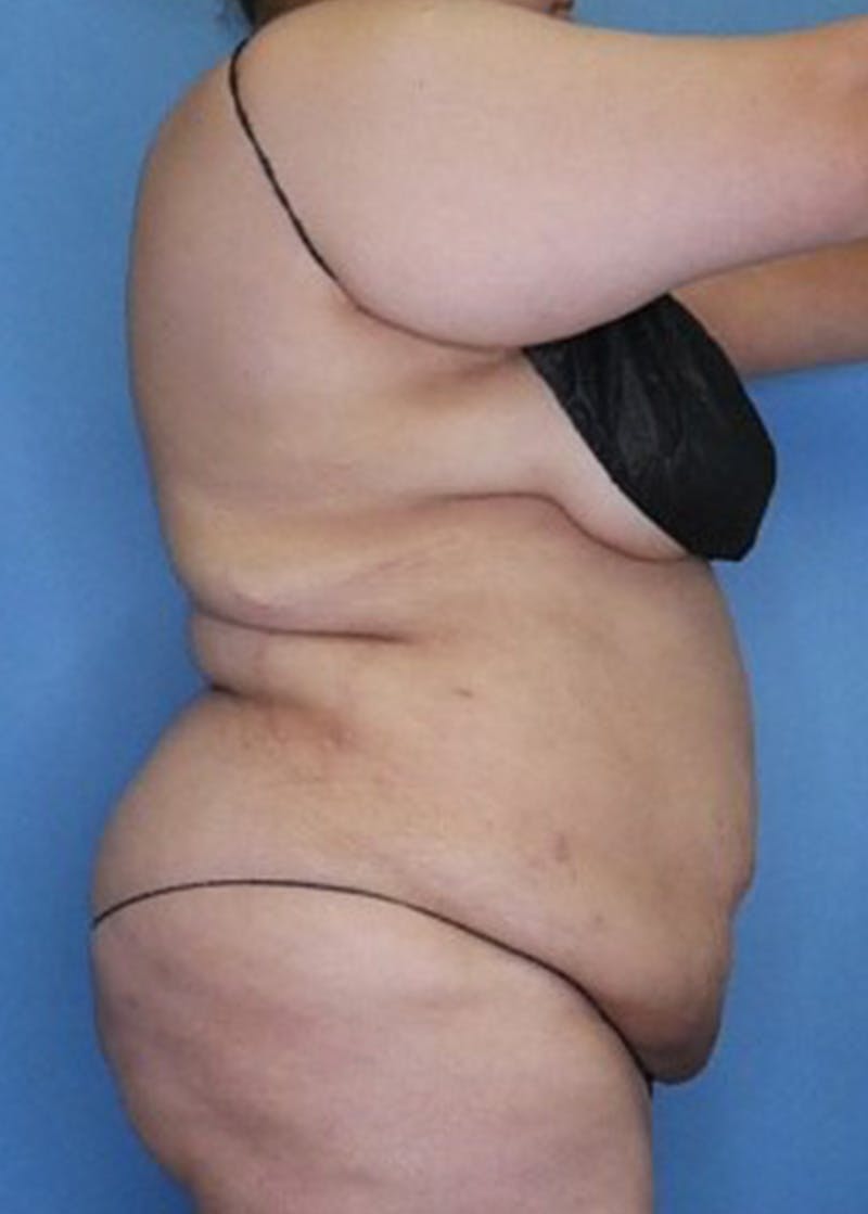 Vaser Liposuction Before & After Gallery - Patient 133182754 - Image 4