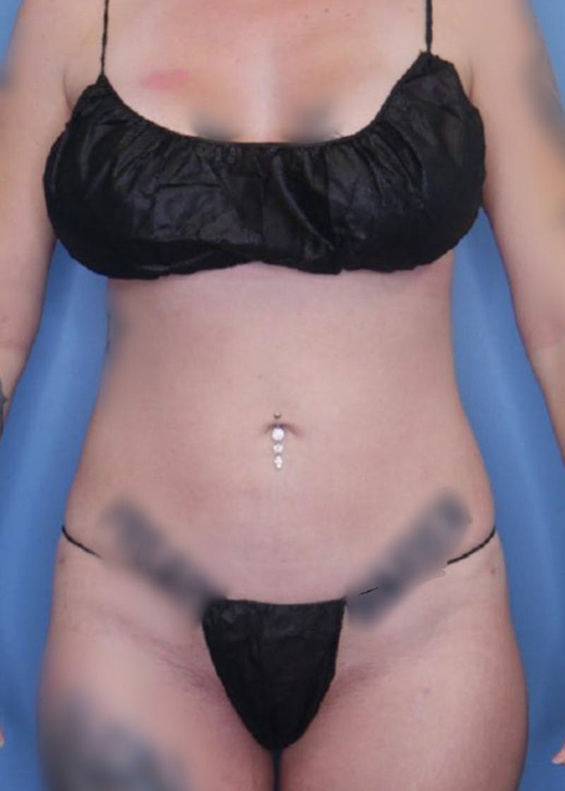 Vaser Liposuction Before & After Gallery - Patient 86841498 - Image 2