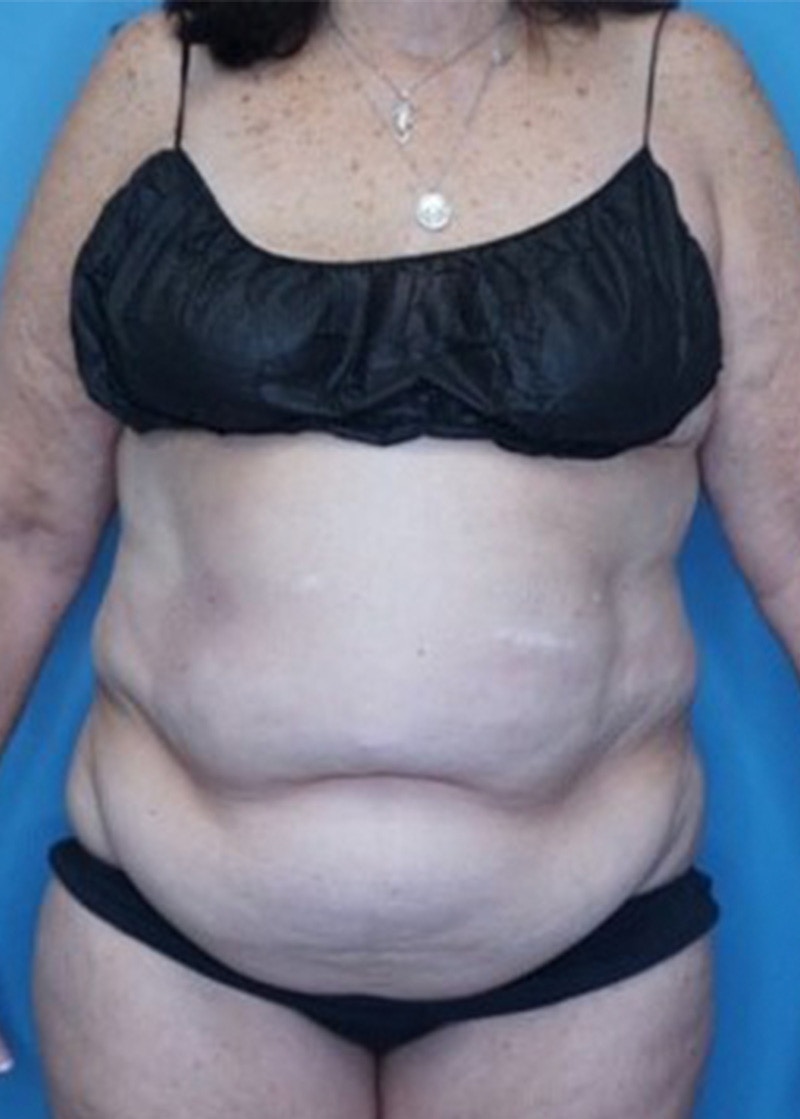 Vaser Liposuction Before & After Gallery - Patient 133182763 - Image 1