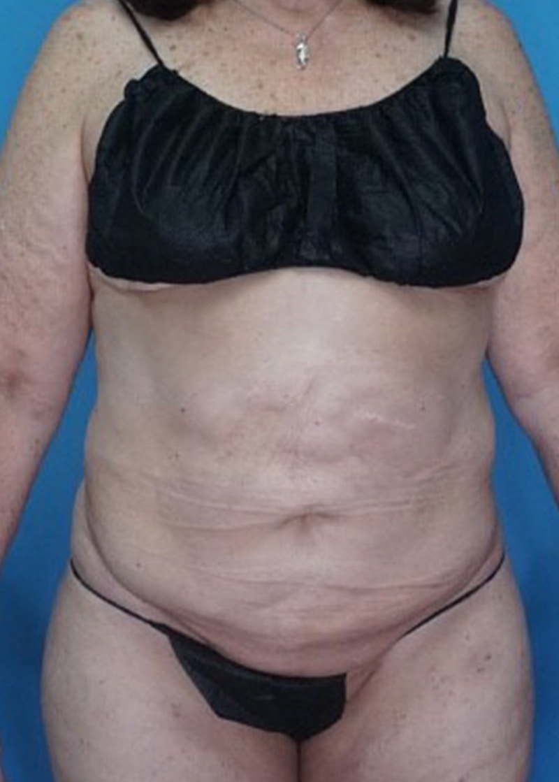 Vaser Liposuction Before & After Gallery - Patient 133182763 - Image 2