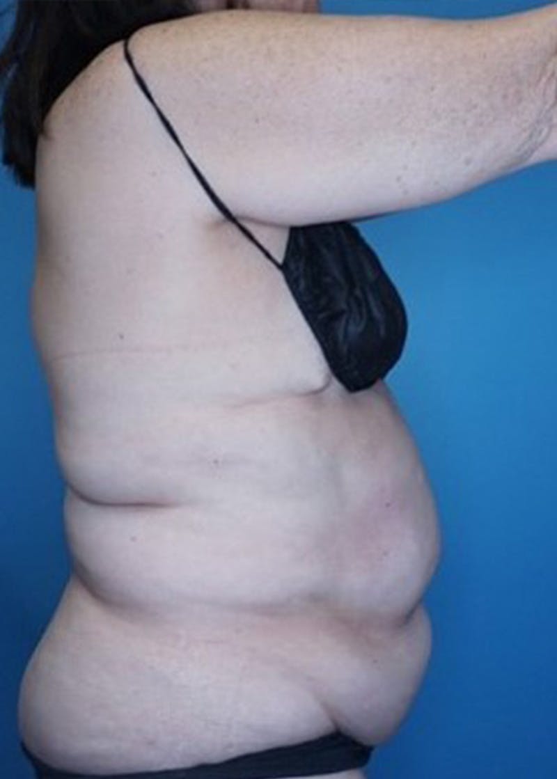 Vaser Liposuction Before & After Gallery - Patient 133182763 - Image 3