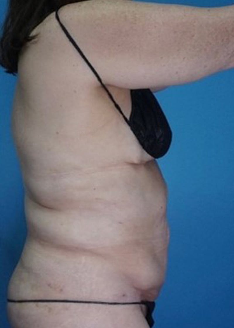 Vaser Liposuction Before & After Gallery - Patient 133182763 - Image 4