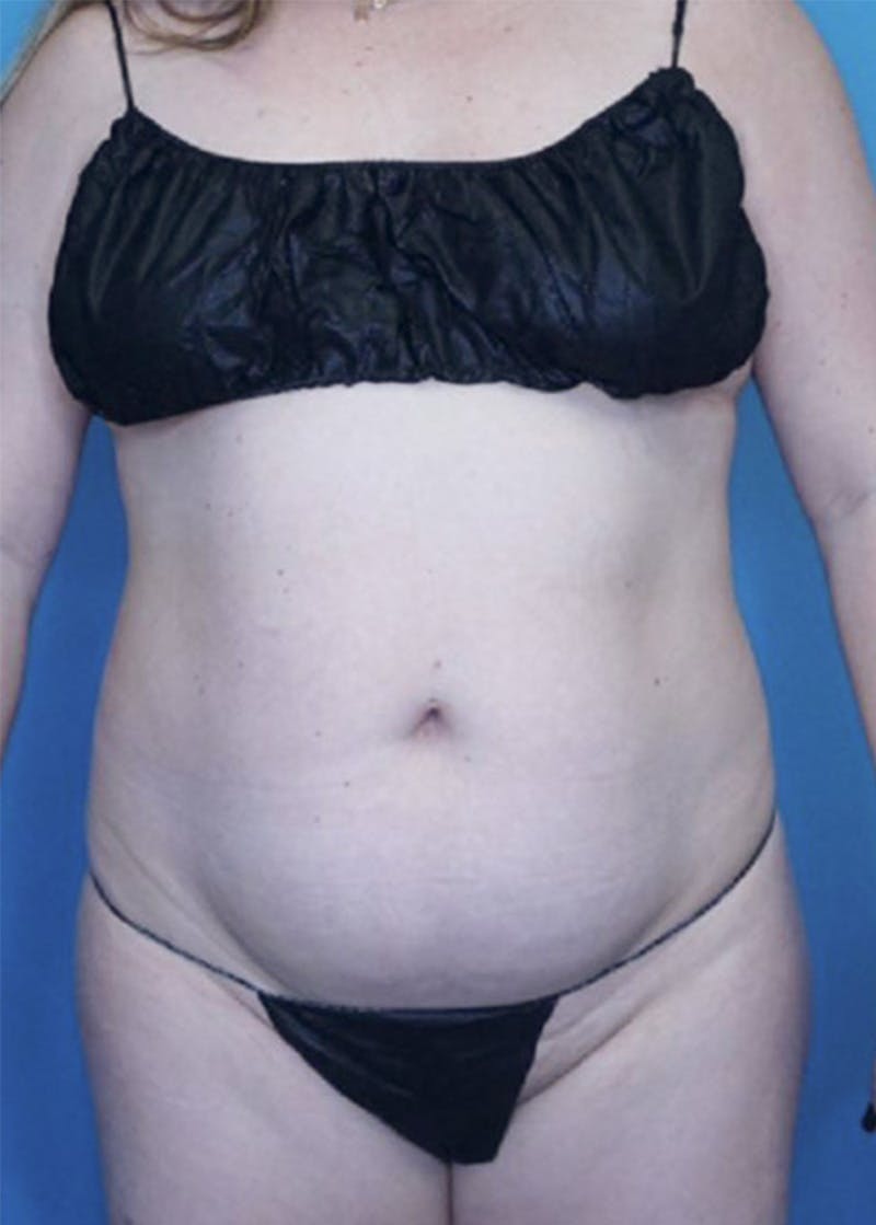 Vaser Liposuction Before & After Gallery - Patient 86837231 - Image 1