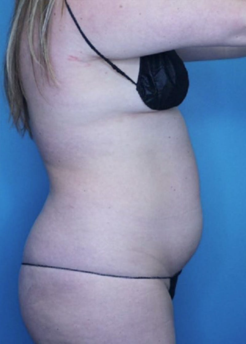 Vaser Liposuction Before & After Gallery - Patient 86837231 - Image 3