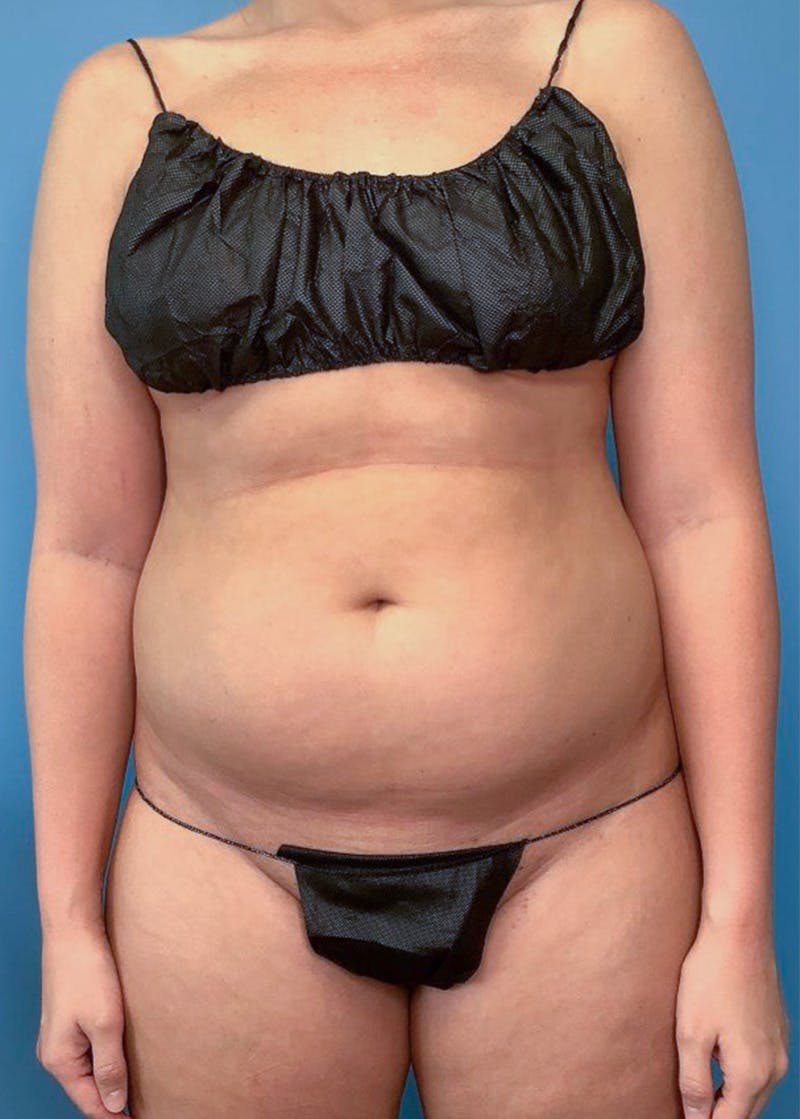 Vaser Liposuction Before & After Gallery - Patient 76667896 - Image 1