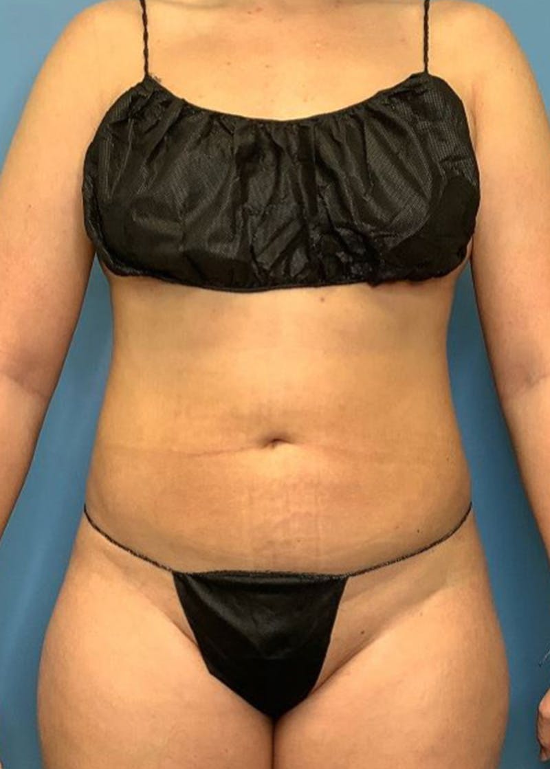 Vaser Liposuction Before & After Gallery - Patient 76667896 - Image 2