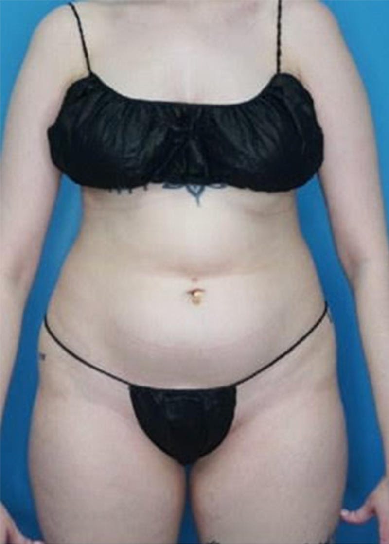 Vaser Liposuction Before & After Gallery - Patient 133182822 - Image 1
