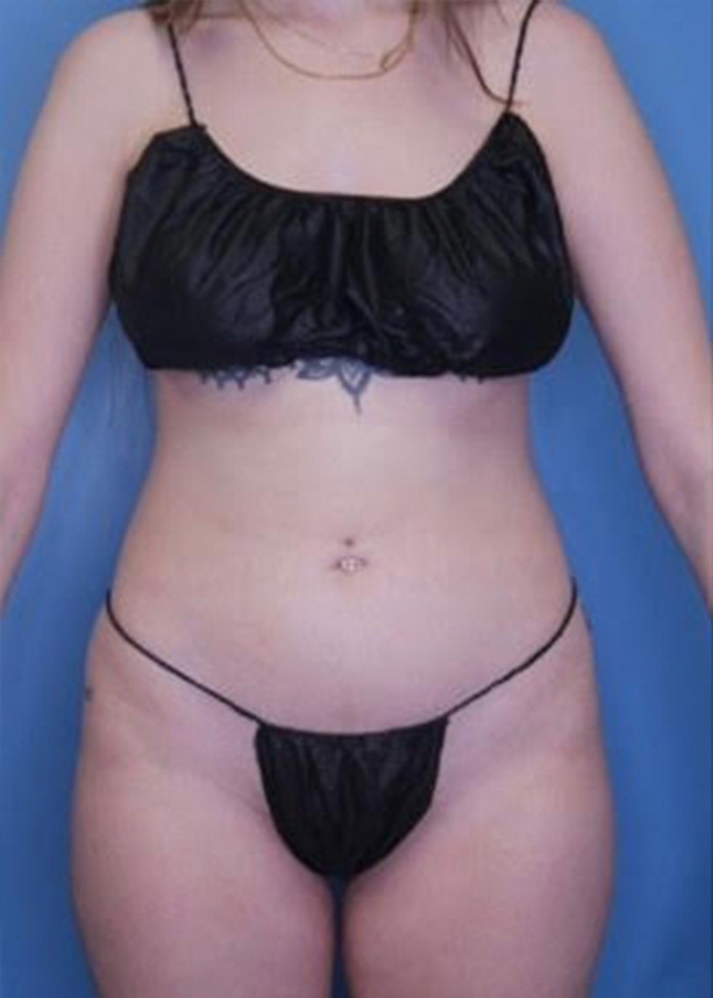 Vaser Liposuction Before & After Gallery - Patient 133182822 - Image 2