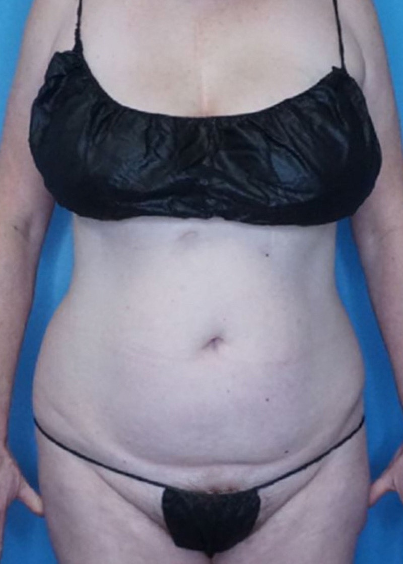 Vaser Liposuction Before & After Gallery - Patient 86806861 - Image 1