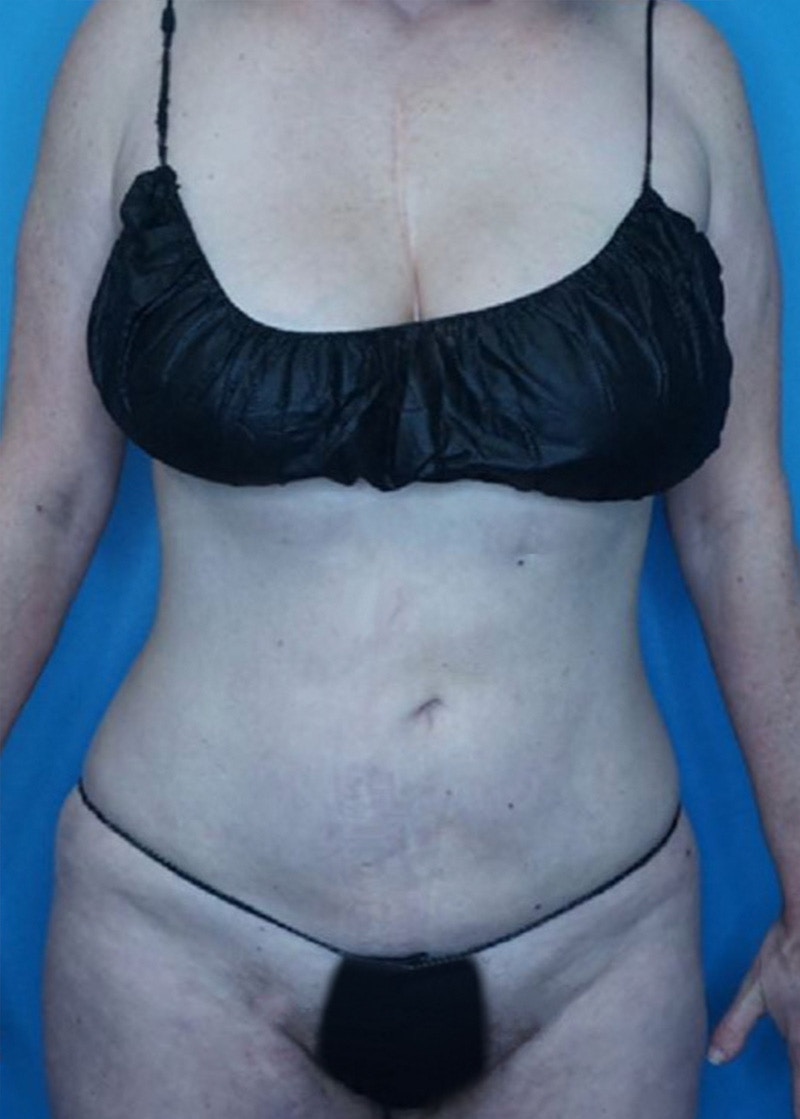 Vaser Liposuction Before & After Gallery - Patient 86806861 - Image 2