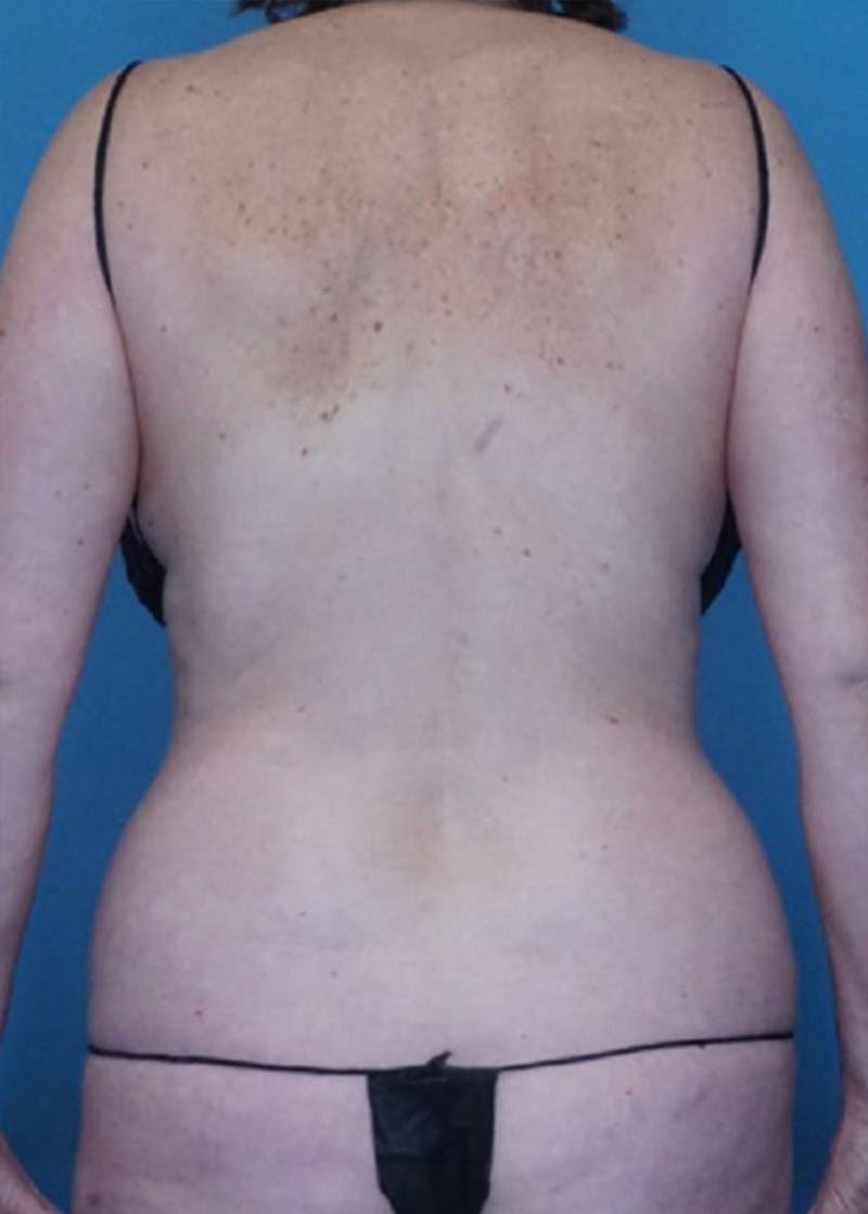 Vaser Liposuction Before & After Gallery - Patient 86806861 - Image 3