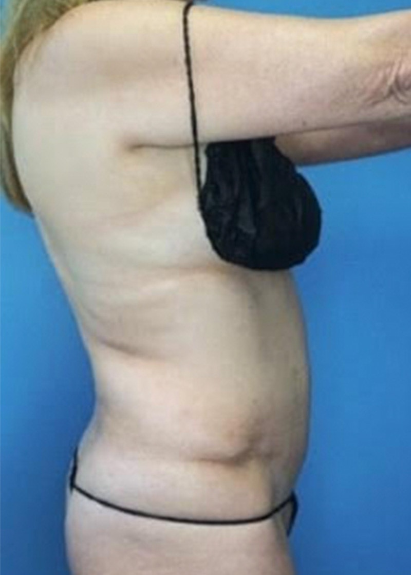Vaser Liposuction Before & After Gallery - Patient 133182825 - Image 1