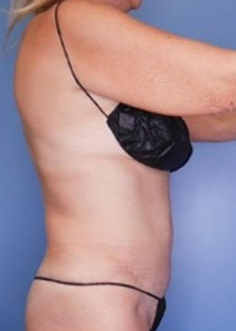 Vaser Liposuction Before & After Gallery - Patient 133182825 - Image 2