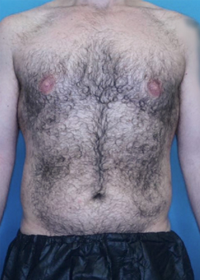 Vaser Liposuction Before & After Gallery - Patient 86837259 - Image 1