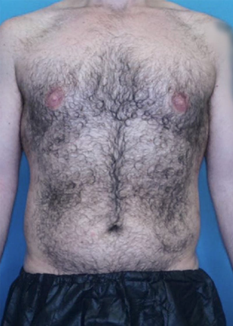 Vaser Liposuction Before & After Gallery - Patient 86837259 - Image 1