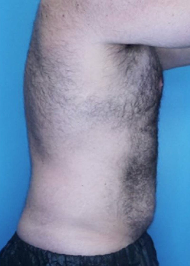 Vaser Liposuction Before & After Gallery - Patient 86837259 - Image 3