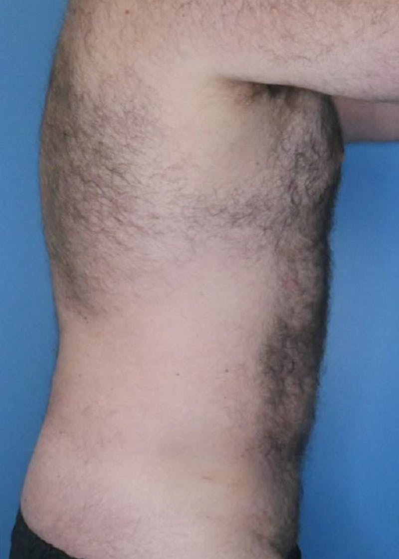 Vaser Liposuction Before & After Gallery - Patient 86837259 - Image 4