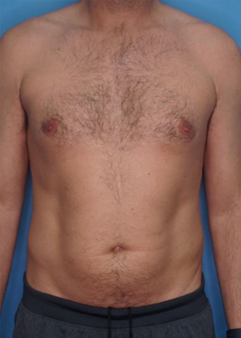 Vaser Liposuction Before & After Gallery - Patient 86645106 - Image 1