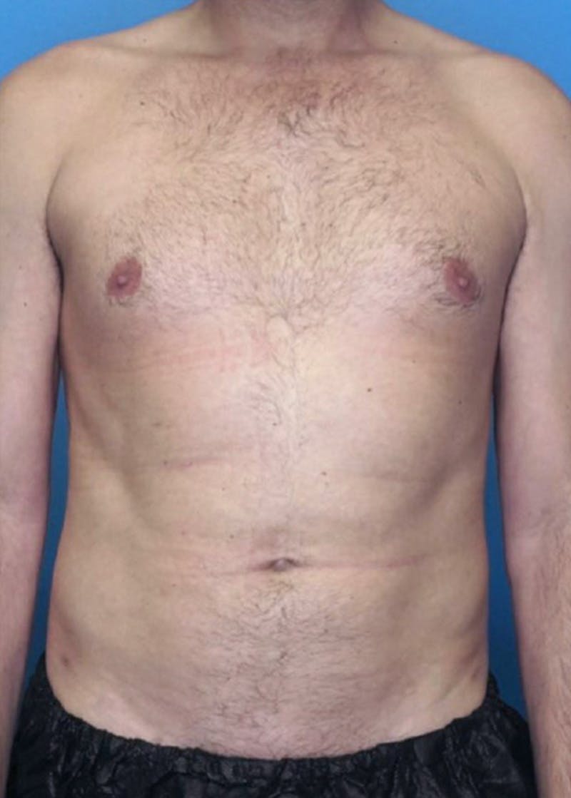 Vaser Liposuction Before & After Gallery - Patient 86645106 - Image 2