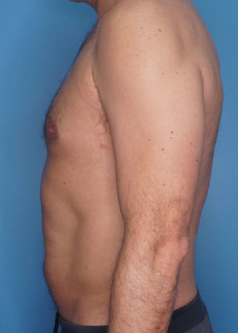 Vaser Liposuction Before & After Gallery - Patient 86645106 - Image 3