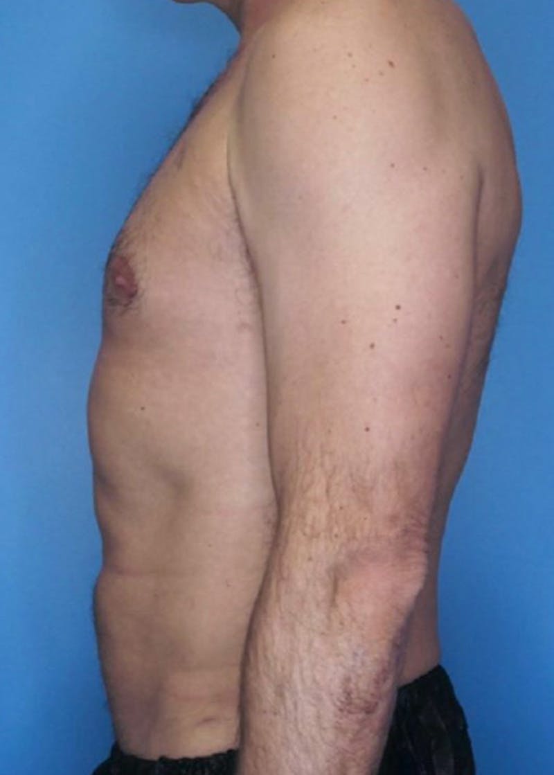 Vaser Liposuction Before & After Gallery - Patient 86645106 - Image 4
