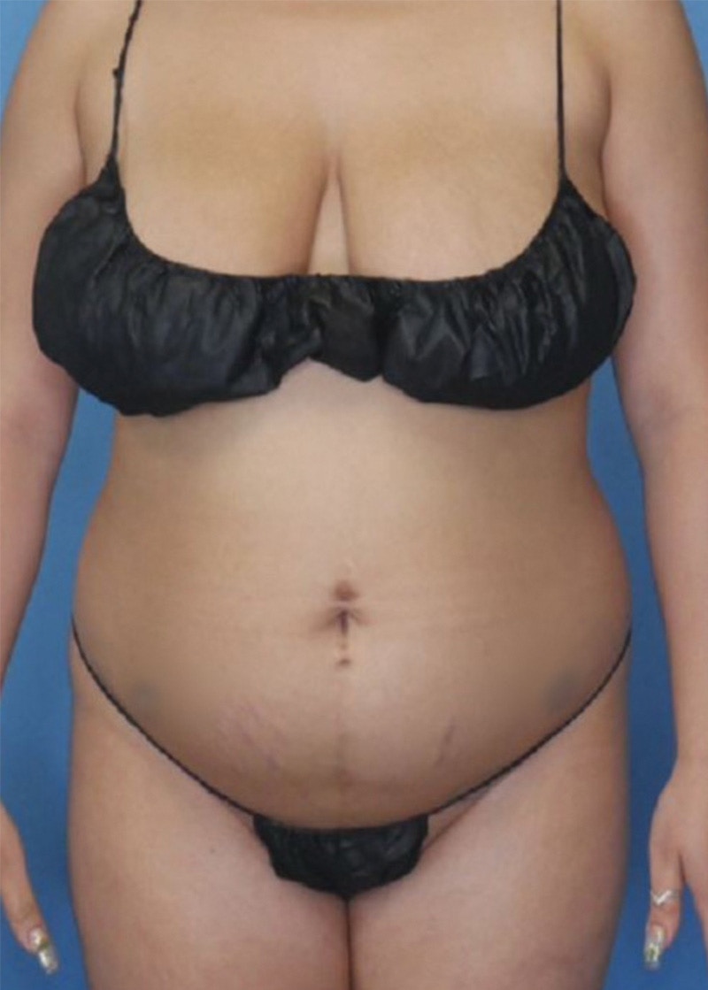 Vaser Liposuction Before & After Gallery - Patient 86841487 - Image 1