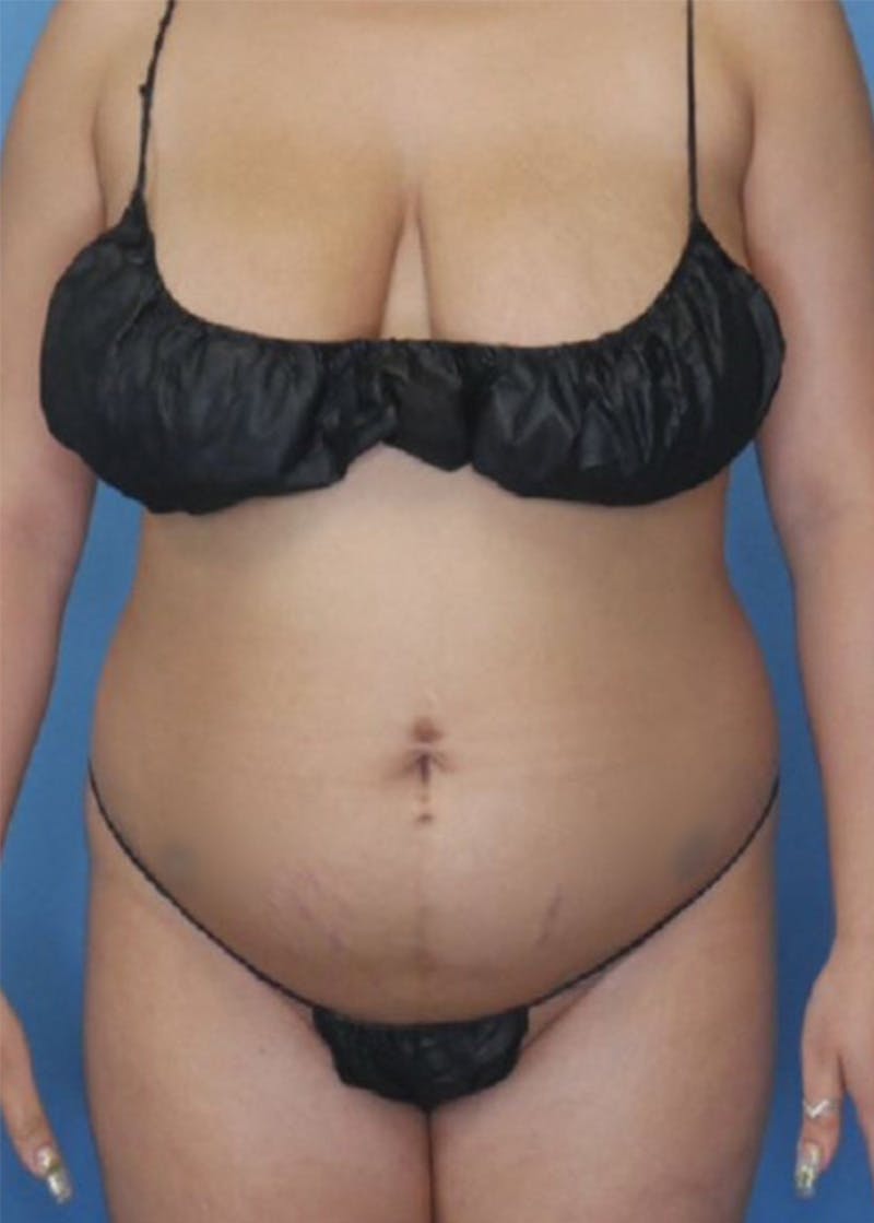 Vaser Liposuction Before & After Gallery - Patient 86841487 - Image 1