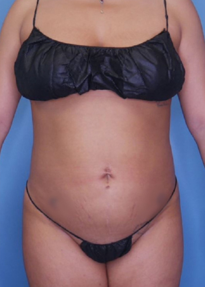 Vaser Liposuction Before & After Gallery - Patient 86841487 - Image 2