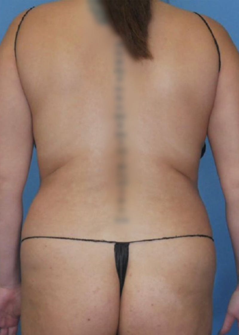 Vaser Liposuction Before & After Gallery - Patient 86841487 - Image 3