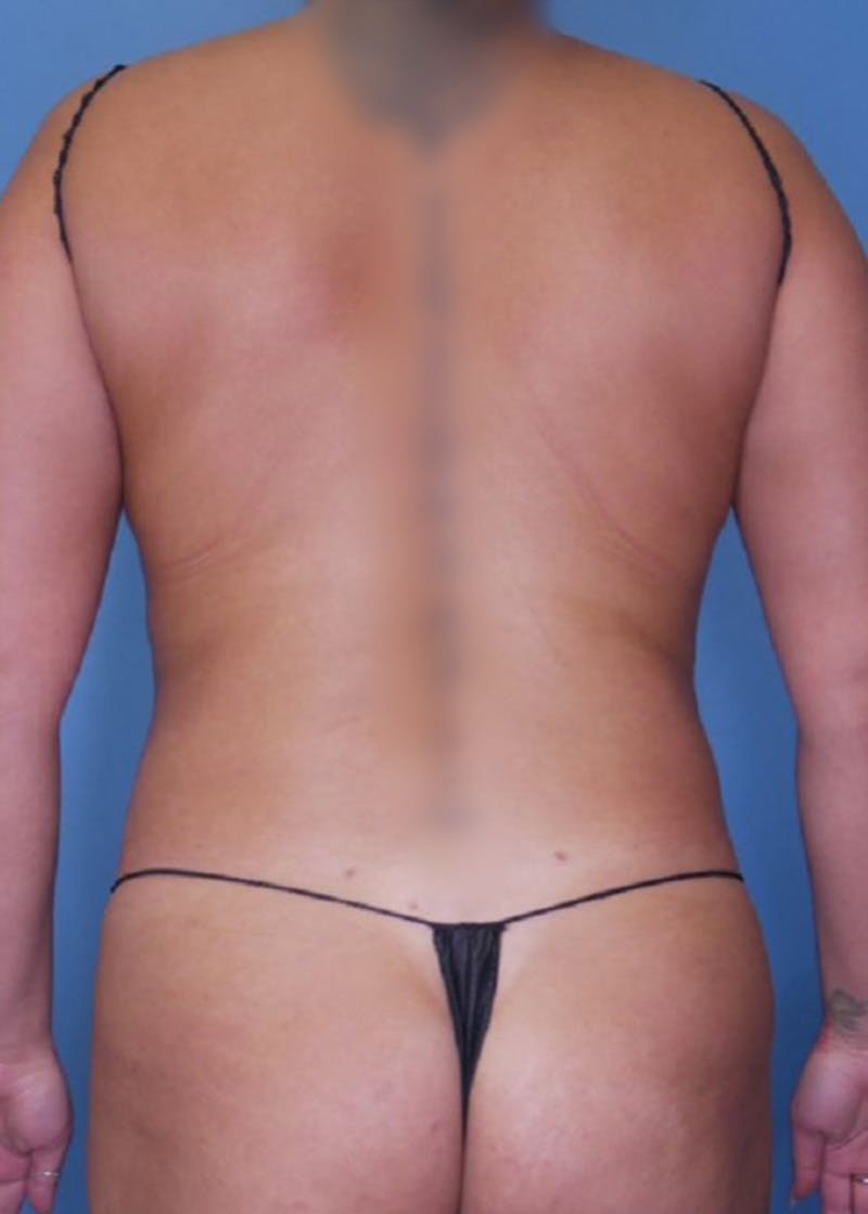 Vaser Liposuction Before & After Gallery - Patient 86841487 - Image 4