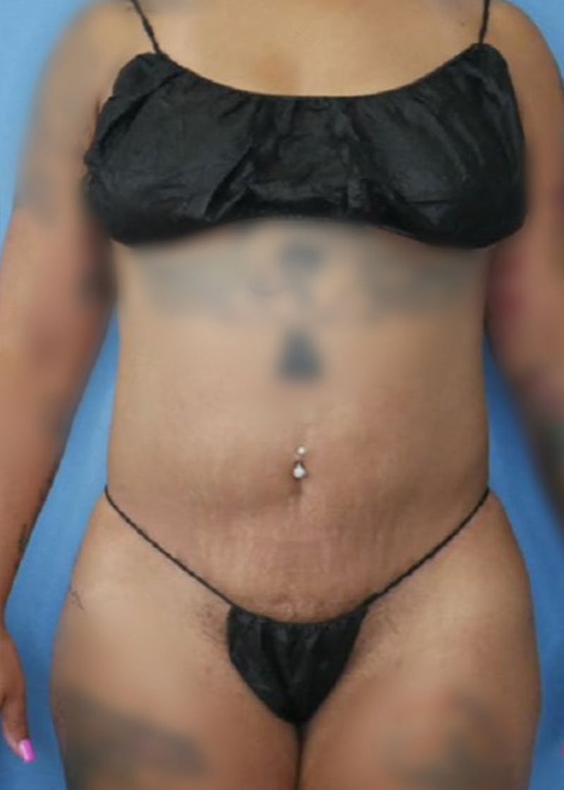 Vaser Liposuction Before & After Gallery - Patient 86837253 - Image 4